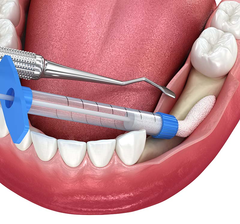 Bone Grafting