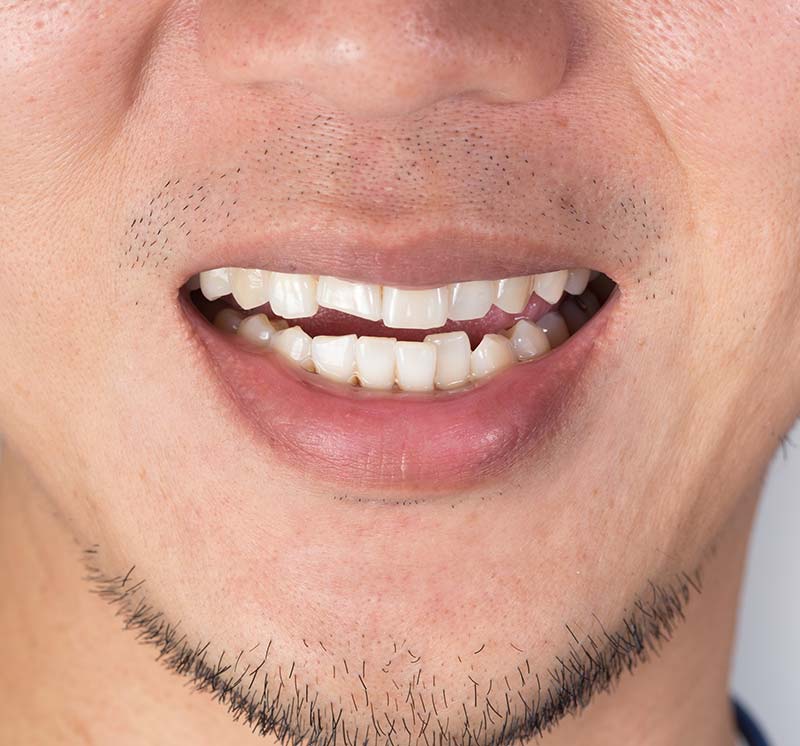 Broken Tooth