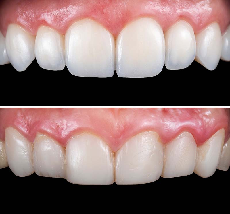 Composite Veneers