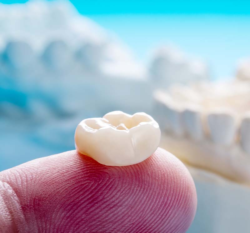 Dental Crowns