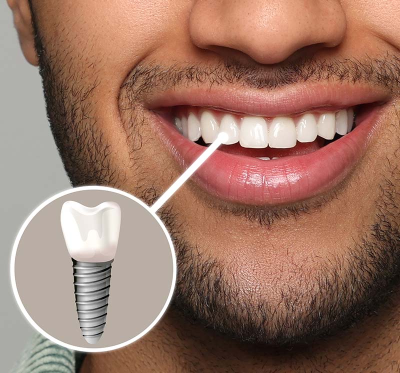 Dental Implant