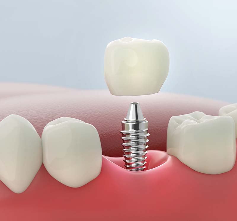 Dental Implant Restoration