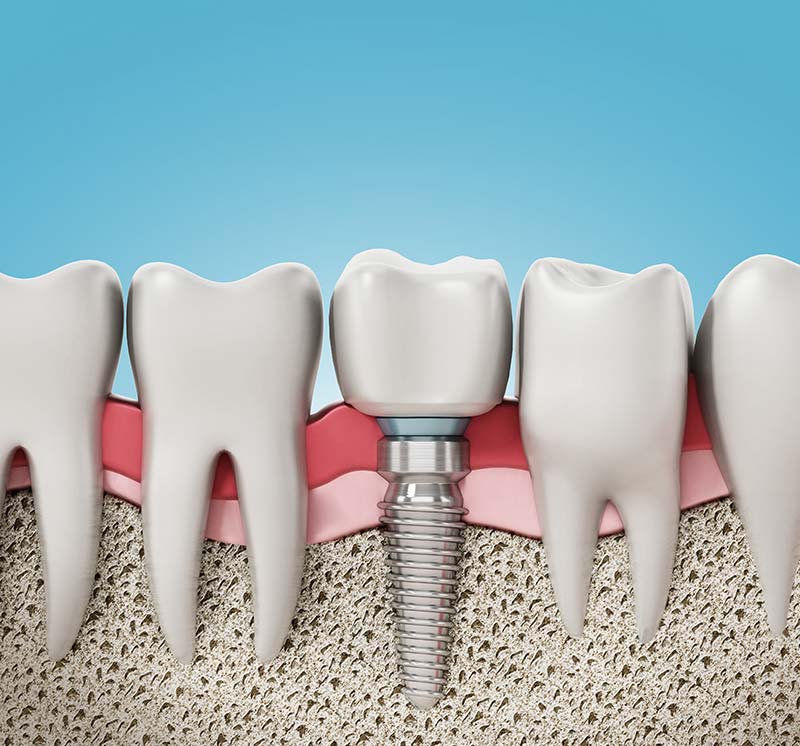 Dental Implant Bone