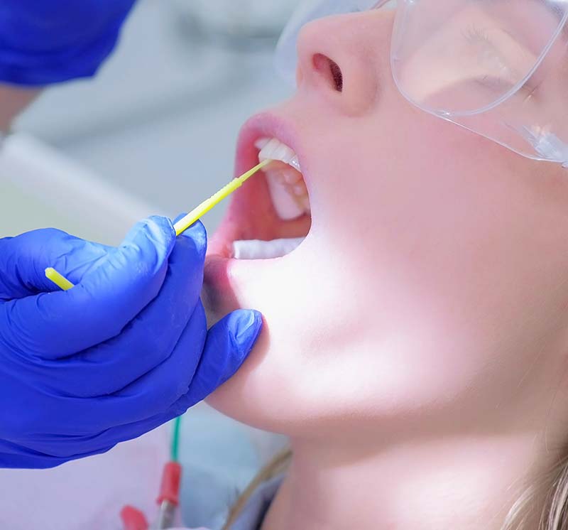 Flouride Treatment Application