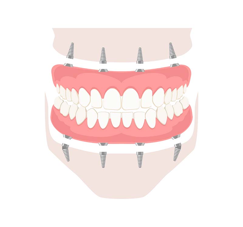 Full Arch Implants