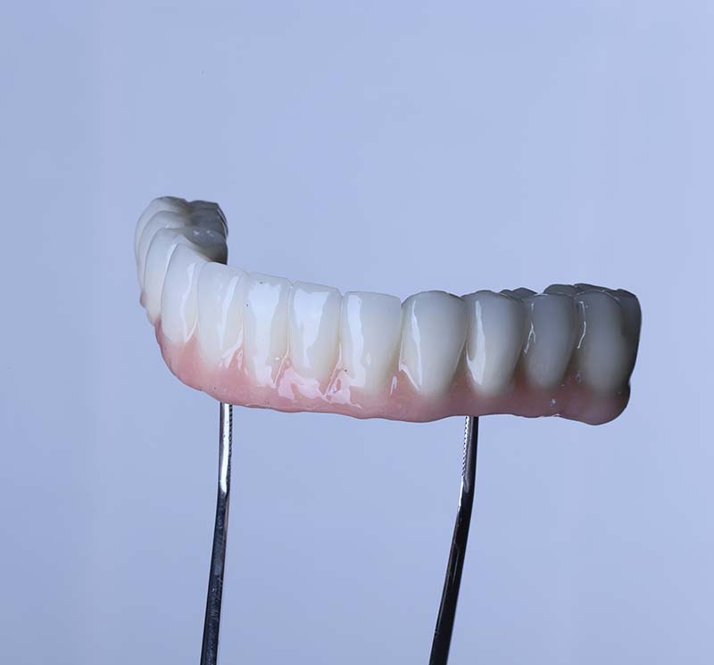 Full Arch Implants