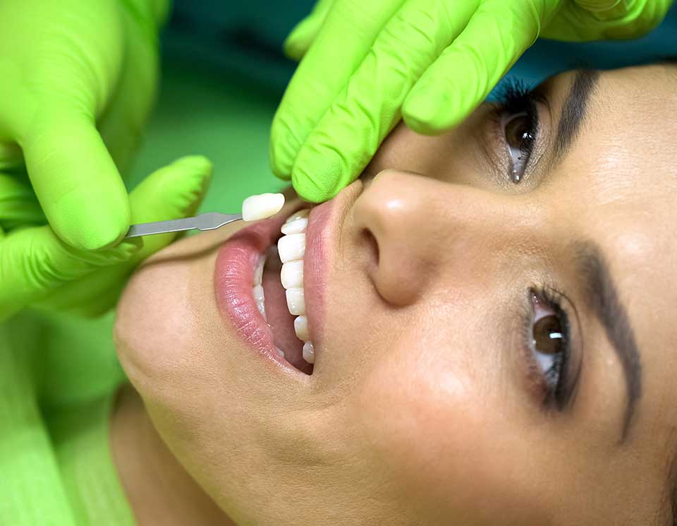 Porcelain Veneers