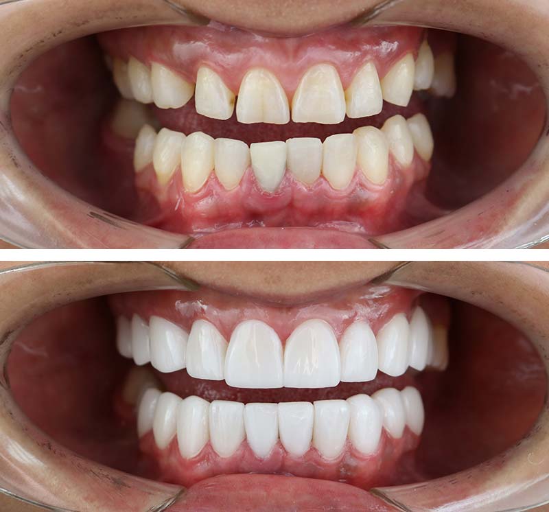 Smile Makeover