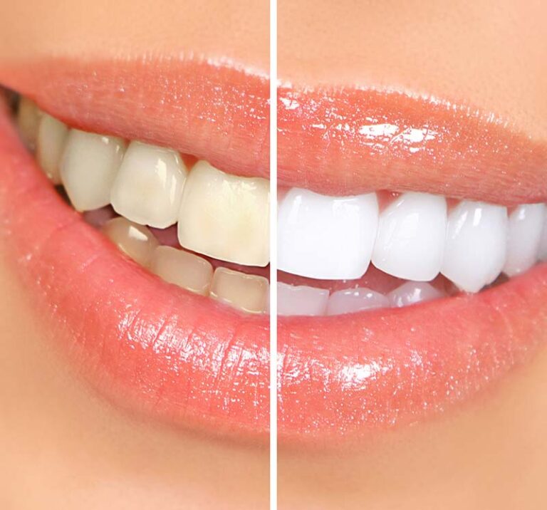 before and after teeth whitening photo