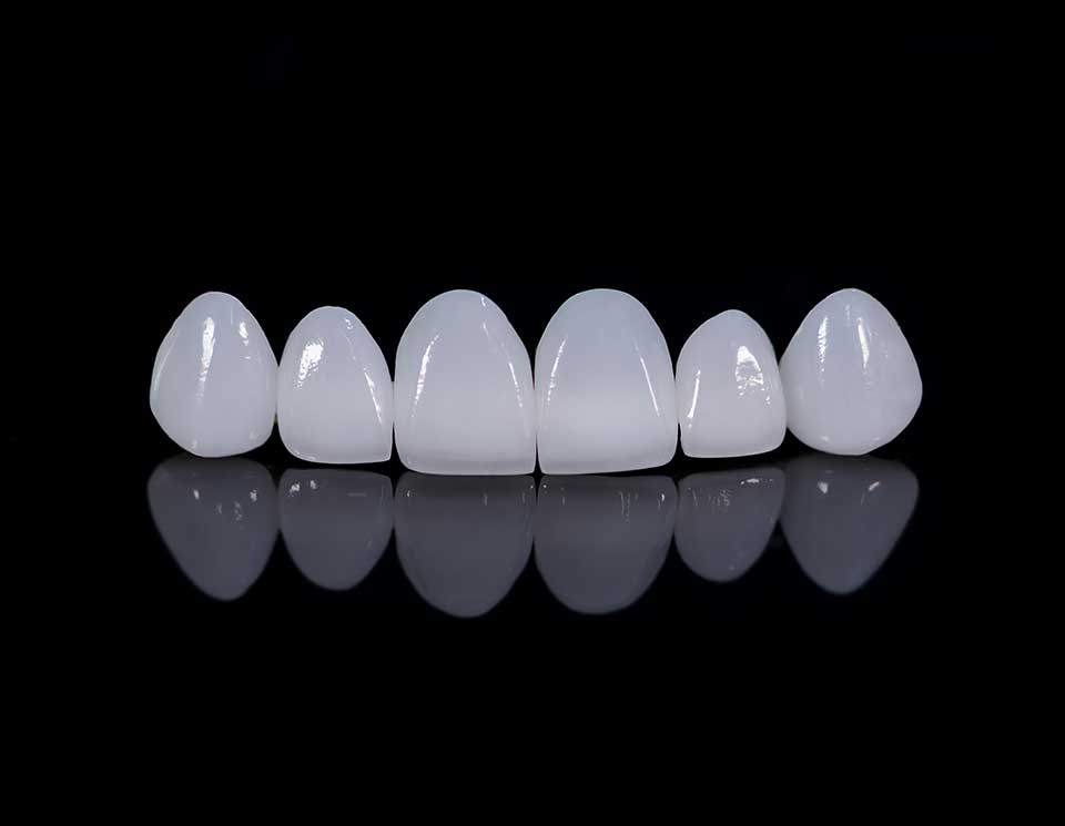 Veneers