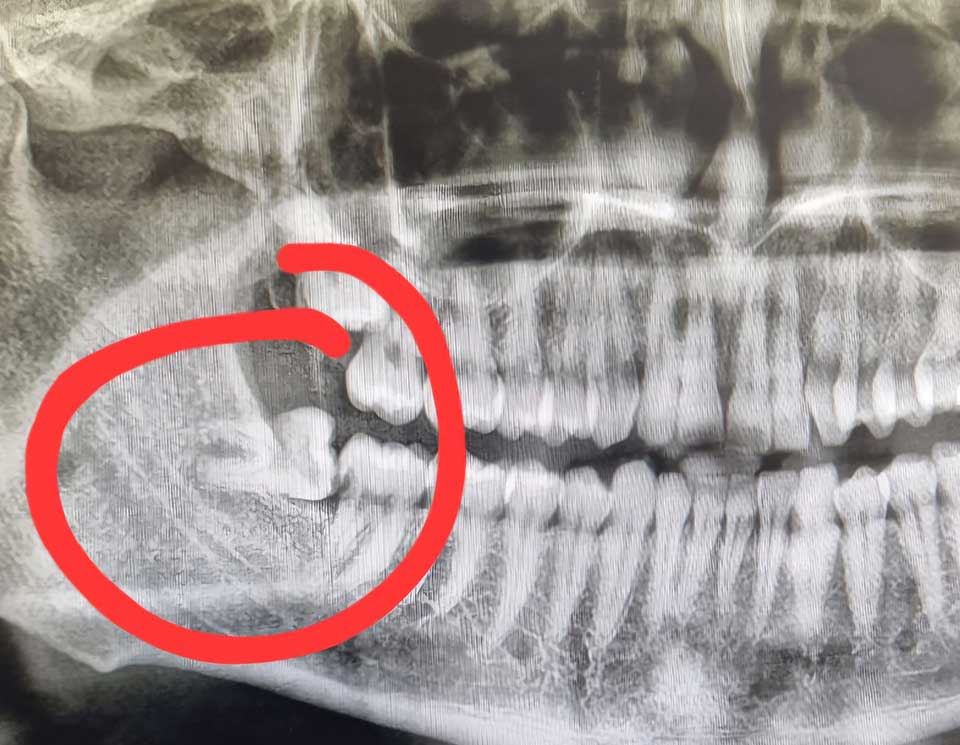 Wisdom Tooth Removal