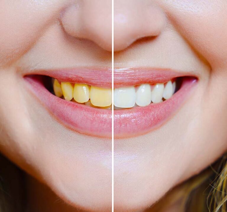 Yellow Teeth vs whiten teeth