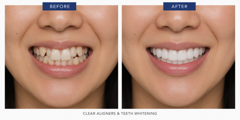 before and after clear aligner and whitening