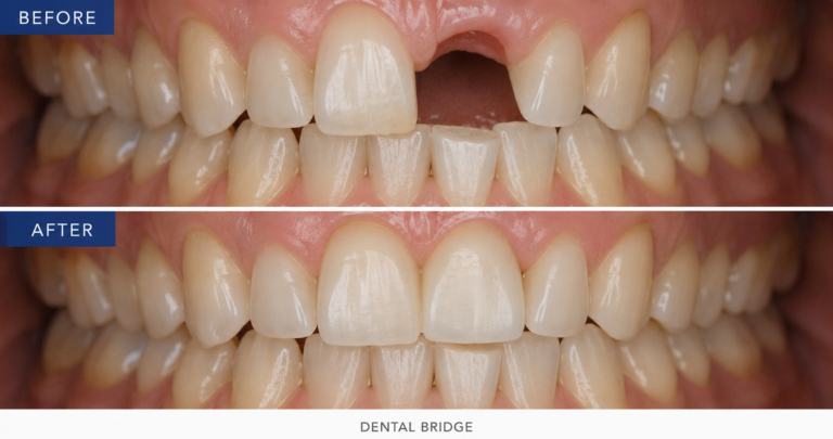 before and after dental bridge